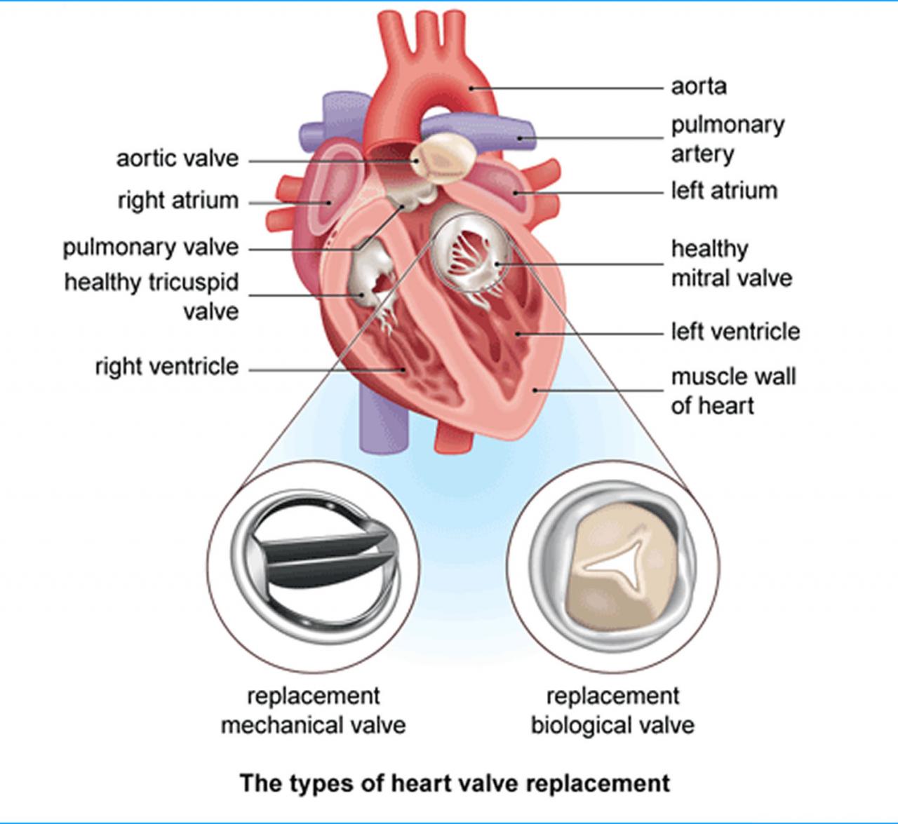 What is the success rate of aortic valve replacement surgery