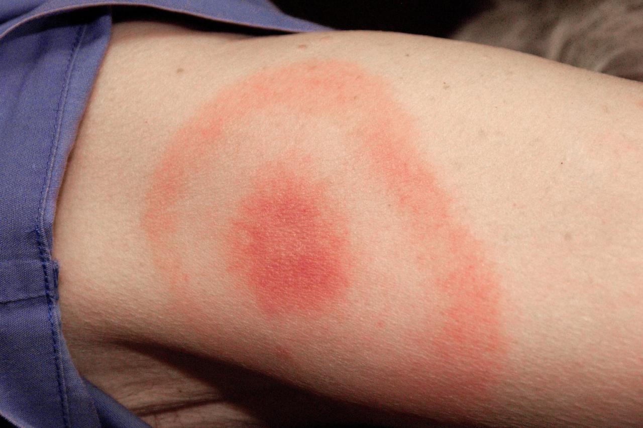 Lyme Disease: Prevalence and Risk Factors