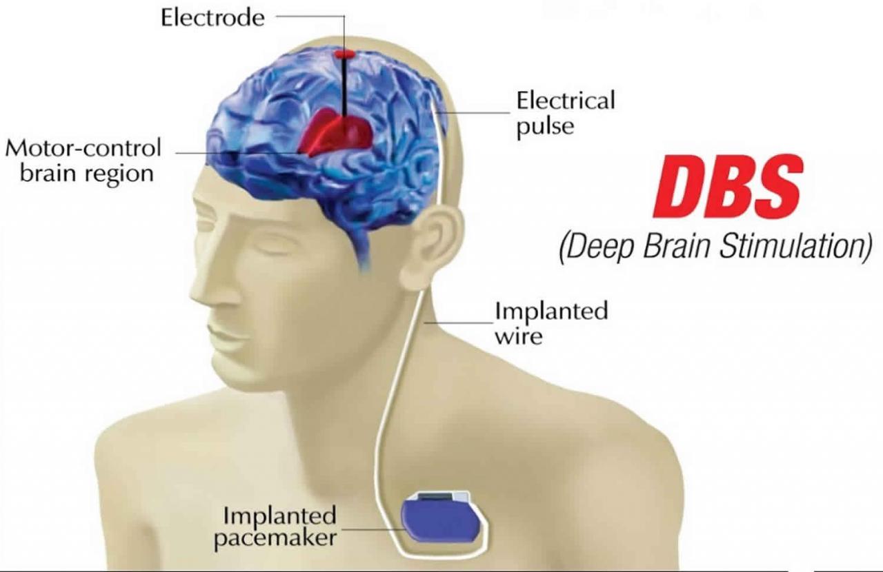 Deep brain stimulation for parkinson's disease success rate