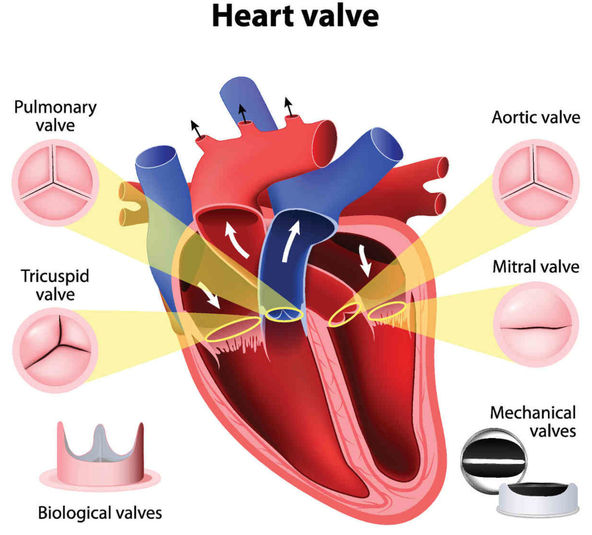 Thoracic aortic aneurysm repair endovascular tevar aorta aneurysms depend risks involved procedure