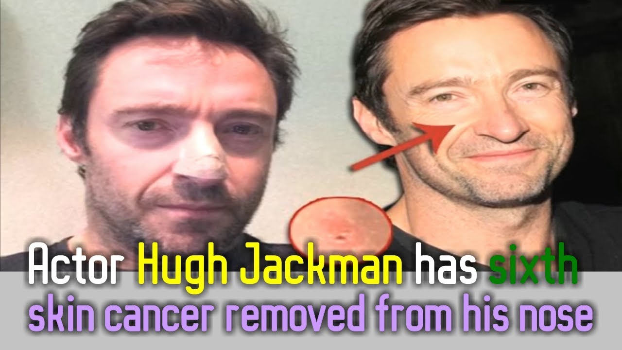 Hugh jackman skin cancer