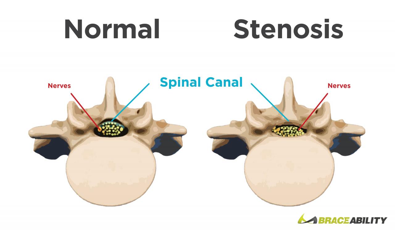 What is the Success Rate of Surgery for Spinal Stenosis?