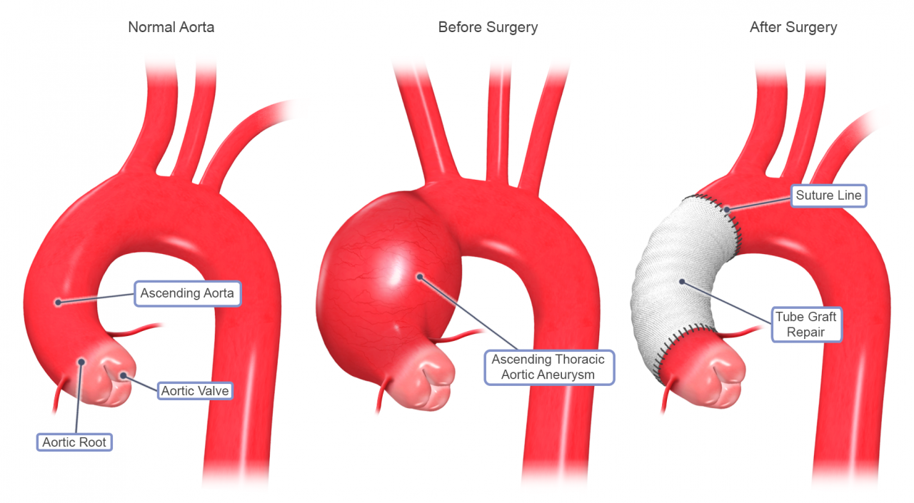 What is the success rate of aortic valve replacement surgery